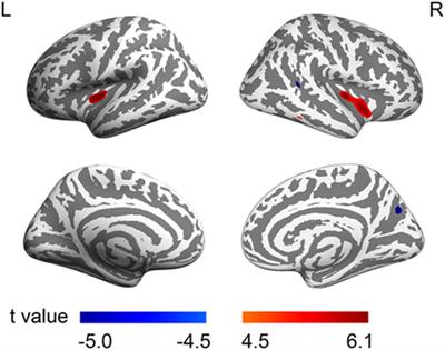 Increased Insular Cortical Thickness Associated With Symptom Severity in Male Youths With Internet Gaming Disorder: A Surface-Based Morphometric Study